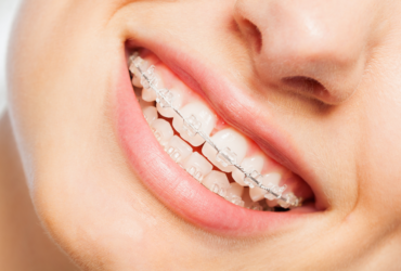 Braces Invisalign