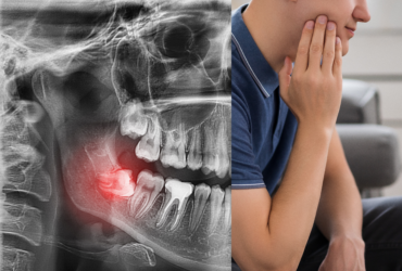 Wisdom Teeth Removal in Okotoks