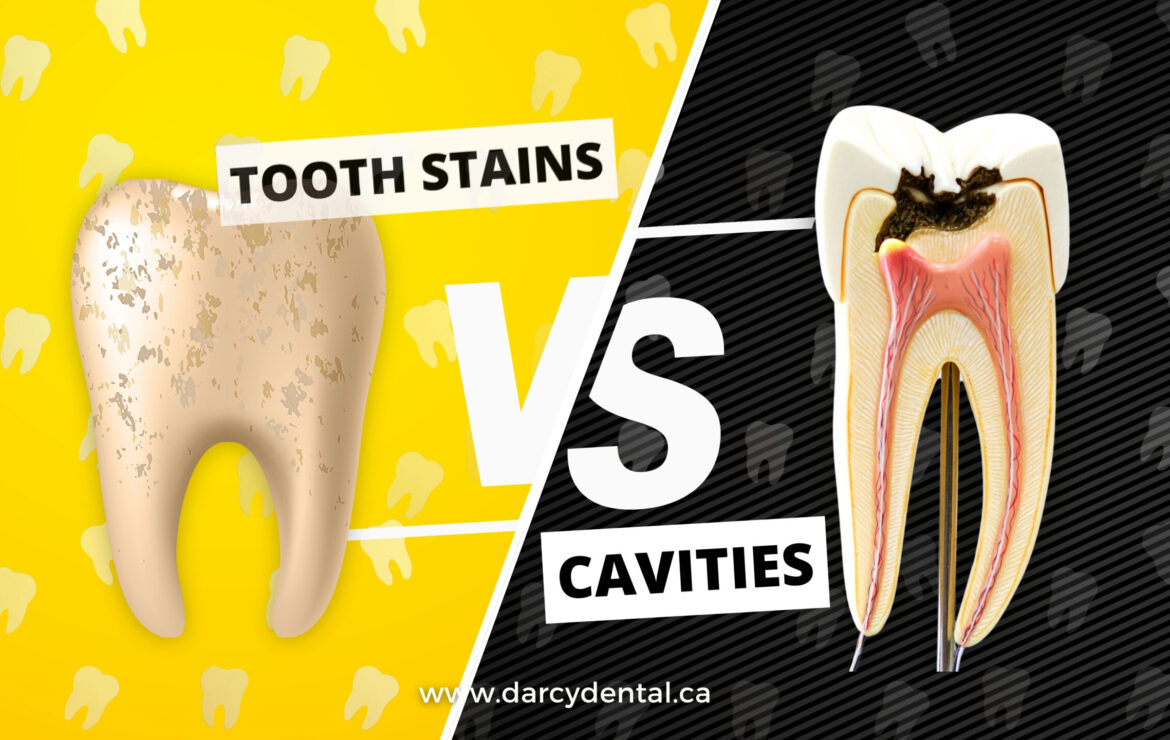 TOOTH STAINS VS. CAVITIES