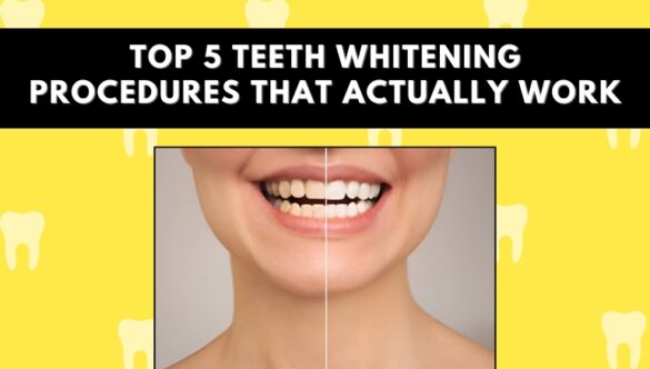 Top 5 Teeth Whitening Procedures That Actually Work