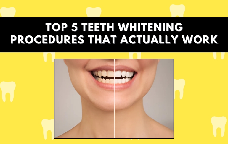 Top 5 Teeth Whitening Procedures That Actually Work